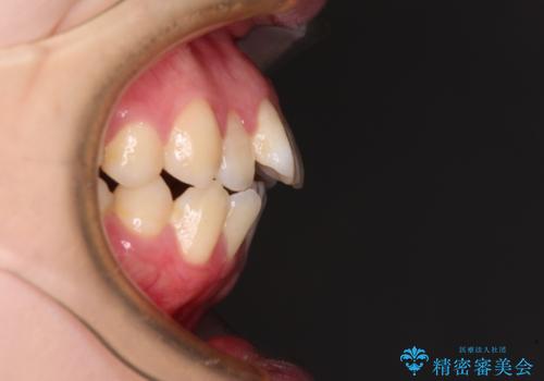 飛び出した上顎前歯 抜歯矯正で横顔の印象を改善の治療前