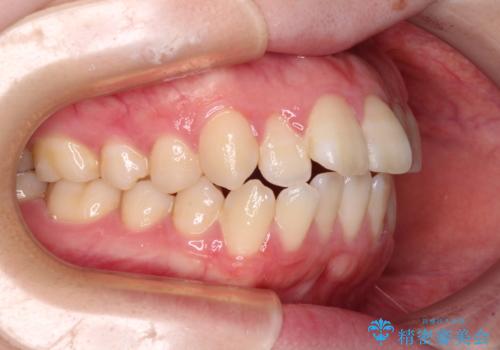 飛び出した上顎前歯 抜歯矯正で横顔の印象を改善の治療前