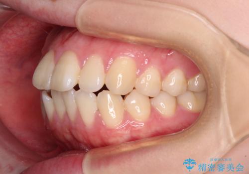 飛び出した上顎前歯 抜歯矯正で横顔の印象を改善の治療前