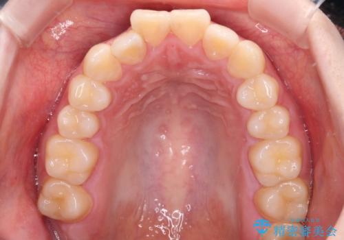 飛び出した上顎前歯　抜歯矯正で横顔の印象を改善の治療前