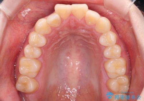 飛び出した上顎前歯 抜歯矯正で横顔の印象を改善の治療前