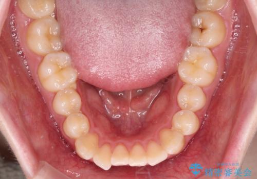 飛び出した上顎前歯 抜歯矯正で横顔の印象を改善の治療前