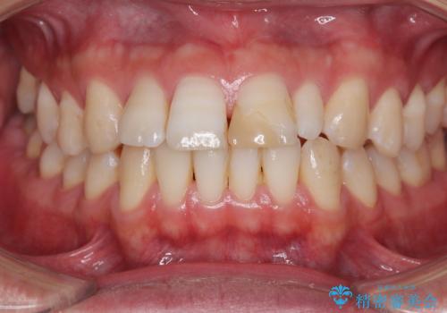 つぎはぎだらけの前歯を周囲と調和させたい　オールセラミッククラウン補綴治療の治療前
