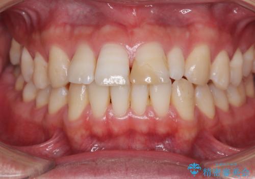 つぎはぎだらけの前歯を周囲と調和させたい オールセラミッククラウン補綴治療の治療前