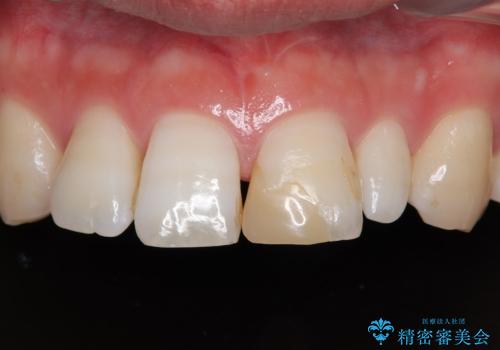 つぎはぎだらけの前歯を周囲と調和させたい オールセラミッククラウン補綴治療の症例 治療前