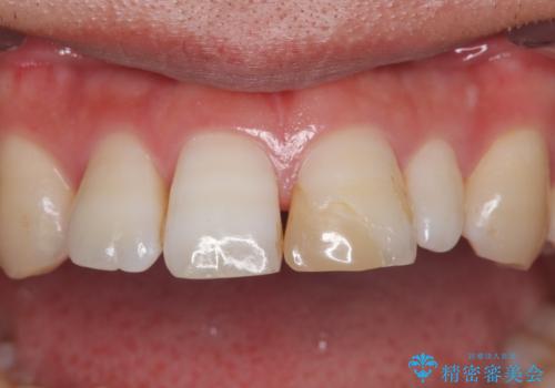 つぎはぎだらけの前歯を周囲と調和させたい オールセラミッククラウン補綴治療の治療前