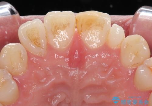 つぎはぎだらけの前歯を周囲と調和させたい　オールセラミッククラウン補綴治療の治療前