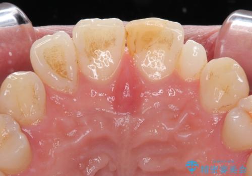 つぎはぎだらけの前歯を周囲と調和させたい オールセラミッククラウン補綴治療の治療前