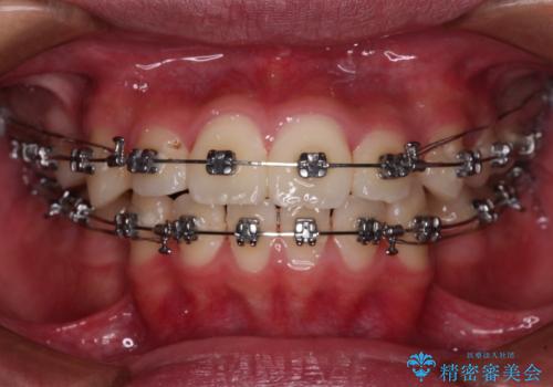 突出した口元 ワイヤー装置で横顔の印象を改善の治療中