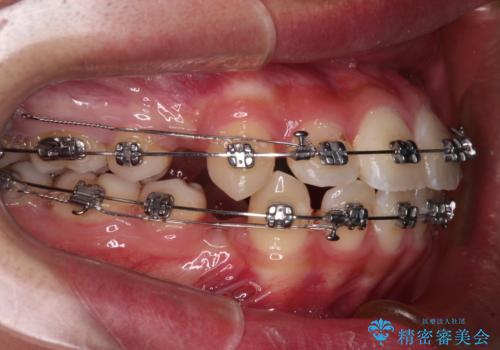突出した口元 ワイヤー装置で横顔の印象を改善の治療中