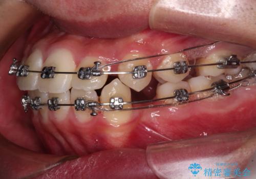 突出した口元 ワイヤー装置で横顔の印象を改善の治療中