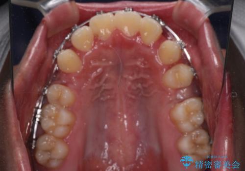 突出した口元 ワイヤー装置で横顔の印象を改善の治療中