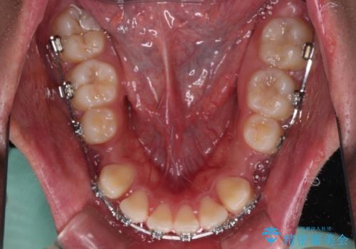突出した口元 ワイヤー装置で横顔の印象を改善の治療中