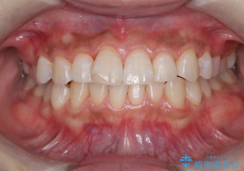 汚れを落としてからオフィスホワイトニングを!