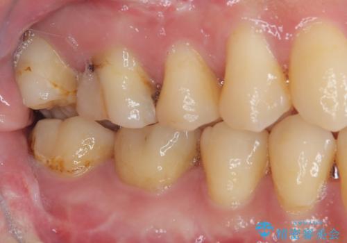 奥歯が痛い オールセラミッククラウンでのむし歯治療の治療前
