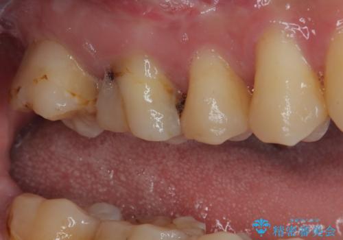 奥歯が痛い オールセラミッククラウンでのむし歯治療の治療前