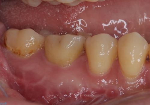 奥歯が痛い オールセラミッククラウンでのむし歯治療の治療前
