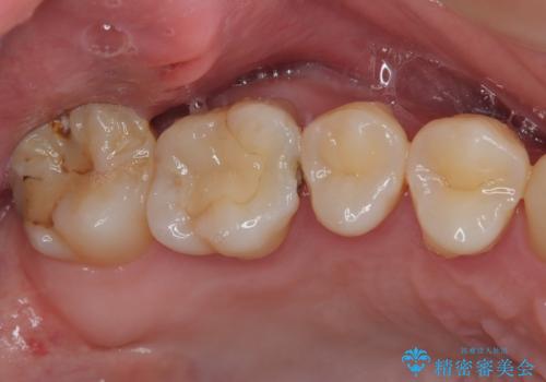 奥歯が痛い オールセラミッククラウンでのむし歯治療の治療前