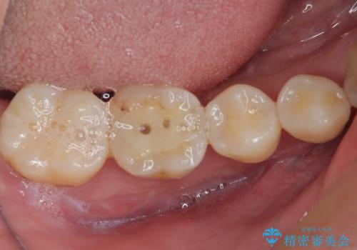 奥歯が痛い オールセラミッククラウンでのむし歯治療の治療前