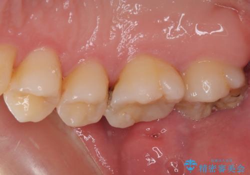 奥歯が痛い オールセラミッククラウンでのむし歯治療の治療前