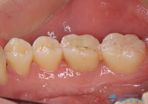 奥歯が痛い オールセラミッククラウンでのむし歯治療の治療前