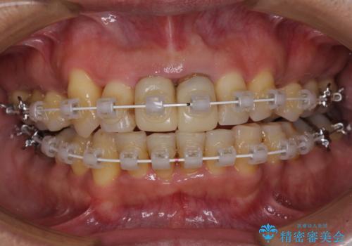 八重歯と突出感を改善 ワイヤー装置での矯正治療の治療中