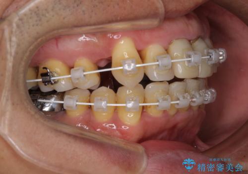 八重歯と突出感を改善 ワイヤー装置での矯正治療の治療中