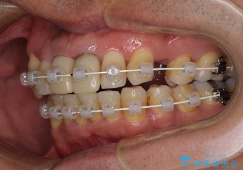 八重歯と突出感を改善 ワイヤー装置での矯正治療の治療中