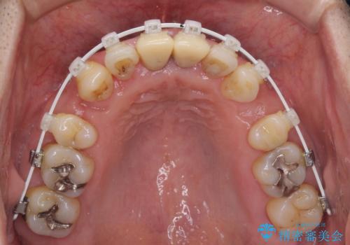 八重歯と突出感を改善　ワイヤー装置での矯正治療の治療中