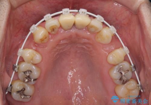八重歯と突出感を改善 ワイヤー装置での矯正治療の治療中