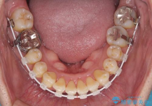 八重歯と突出感を改善 ワイヤー装置での矯正治療の治療中