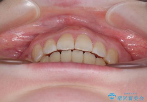 飛び出した上顎前歯 抜歯矯正で横顔の印象を改善の治療後