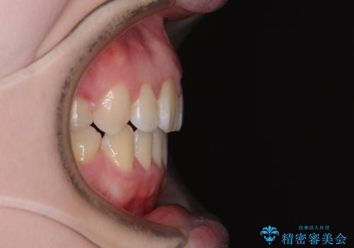 飛び出した上顎前歯 抜歯矯正で横顔の印象を改善の治療後