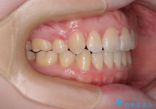 飛び出した上顎前歯 抜歯矯正で横顔の印象を改善の治療後