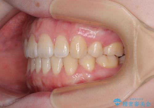 飛び出した上顎前歯 抜歯矯正で横顔の印象を改善の治療後