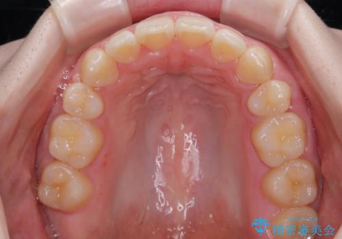 飛び出した上顎前歯　抜歯矯正で横顔の印象を改善の治療後
