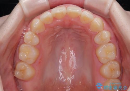 飛び出した上顎前歯 抜歯矯正で横顔の印象を改善の治療後