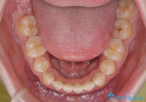 飛び出した上顎前歯 抜歯矯正で横顔の印象を改善の治療後