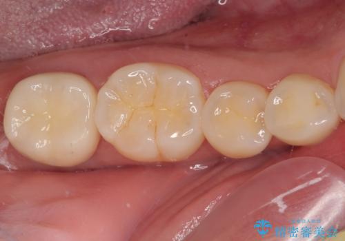 親知らずに影響で大きなむし歯に　セラミッククラウンによるむし歯治療の治療後