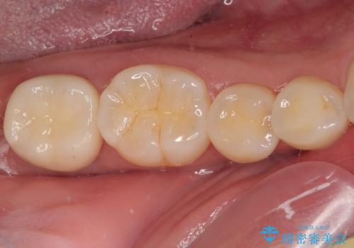 親知らずに影響で大きなむし歯に セラミッククラウンによるむし歯治療の症例 治療後