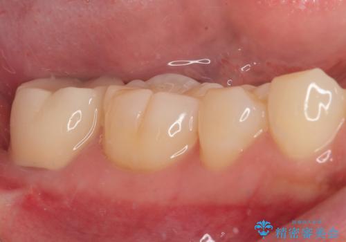 親知らずに影響で大きなむし歯に　セラミッククラウンによるむし歯治療の治療後