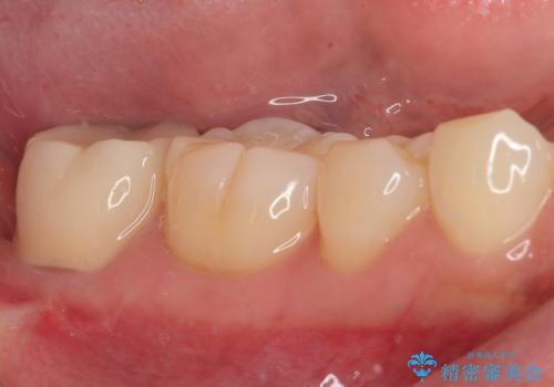 親知らずに影響で大きなむし歯に セラミッククラウンによるむし歯治療