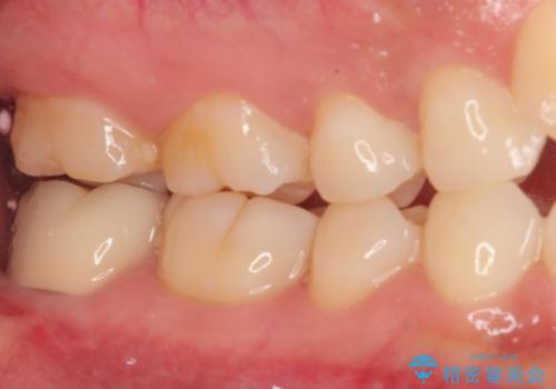 親知らずに影響で大きなむし歯に セラミッククラウンによるむし歯治療の治療後