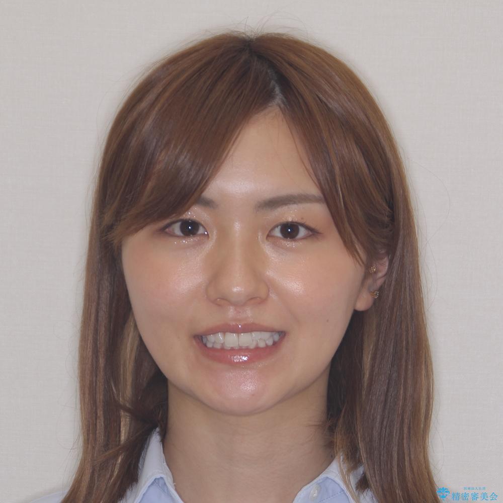 【モニター】前歯のデコボコと小さい前歯 インビザライン矯正とオールセラミッククラウン補綴治療の治療前(顔貌)