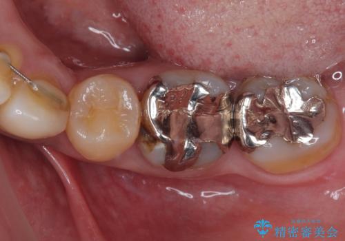 銀歯の入った歯が欠けた 奥歯のオールセラミッククラウン補綴治療の症例 治療前