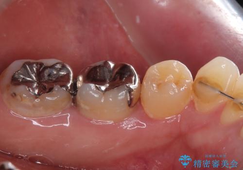 銀歯の入った歯が欠けた 奥歯のオールセラミッククラウン補綴治療の治療前