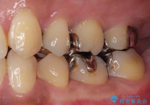 銀歯の入った歯が欠けた　奥歯のオールセラミッククラウン補綴治療の治療前