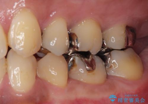 銀歯の入った歯が欠けた 奥歯のオールセラミッククラウン補綴治療の治療前