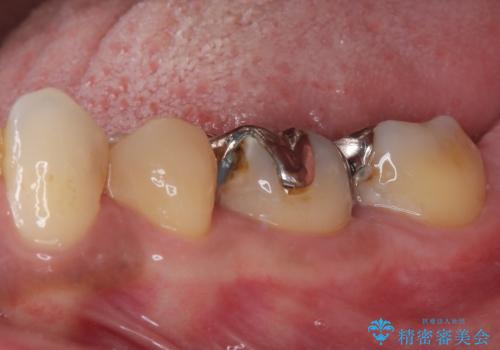 銀歯の入った歯が欠けた 奥歯のオールセラミッククラウン補綴治療の治療前