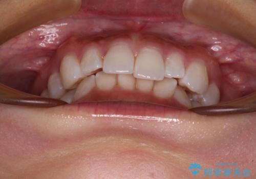 【モニター】前歯のデコボコと小さい前歯 インビザライン矯正とオールセラミッククラウン補綴治療の治療前